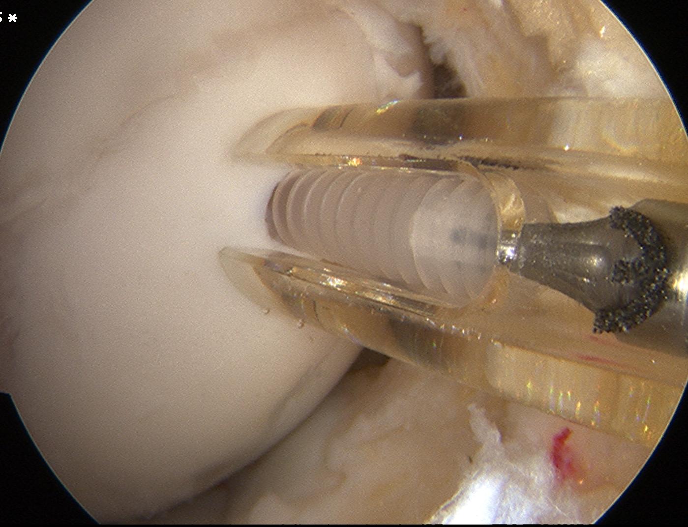 Femoral OCD Screw Insertion